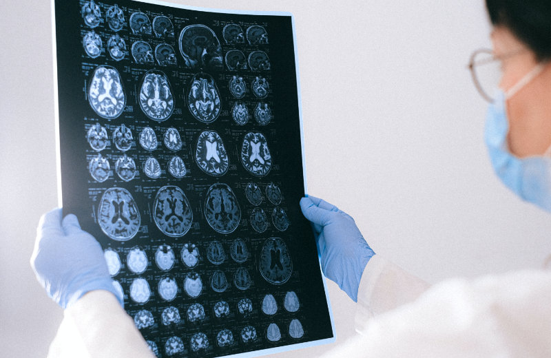 I tumori cerebrali potrebbero diventare curabili in futuro » Leadersnet